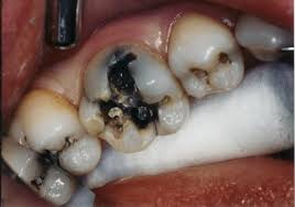 Chân răng bị đen phải làm thế nào