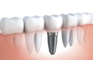 Răng giả implant