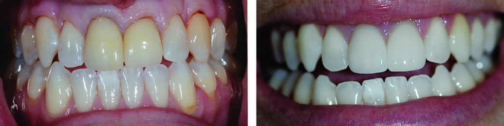 two front teeth veneers and teeth whitening to remove yellow staining